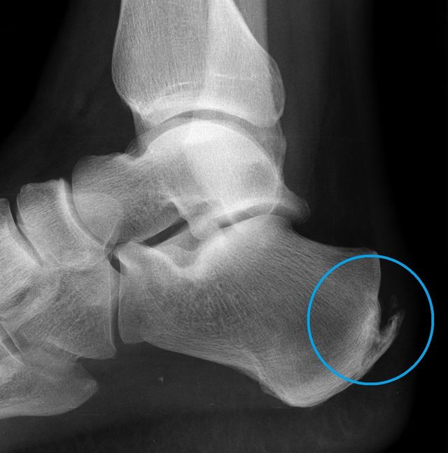 Pictures of heel hot sale bone spurs